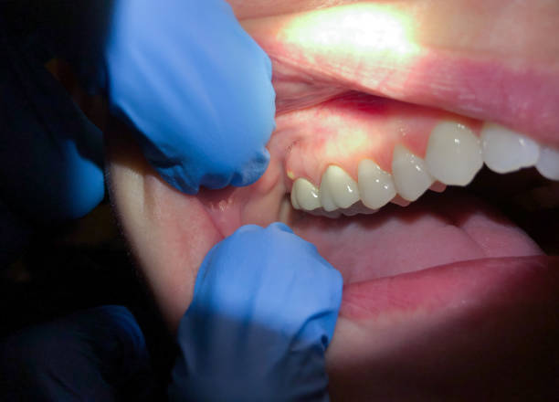 Best Emergency Root Canal Treatment in Tresckow, PA